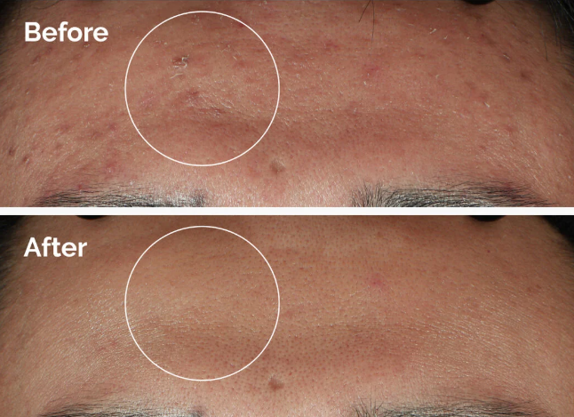 The Ordinary Ácido Glicólico💧