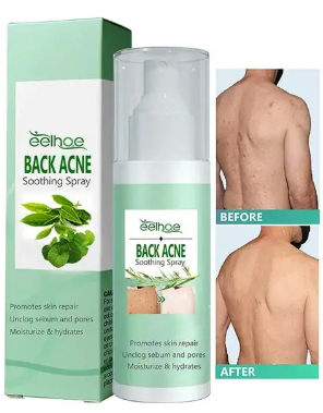 ADIÓS AL ACNÉ 🌿ELIMINA ESO GRANITOS💧